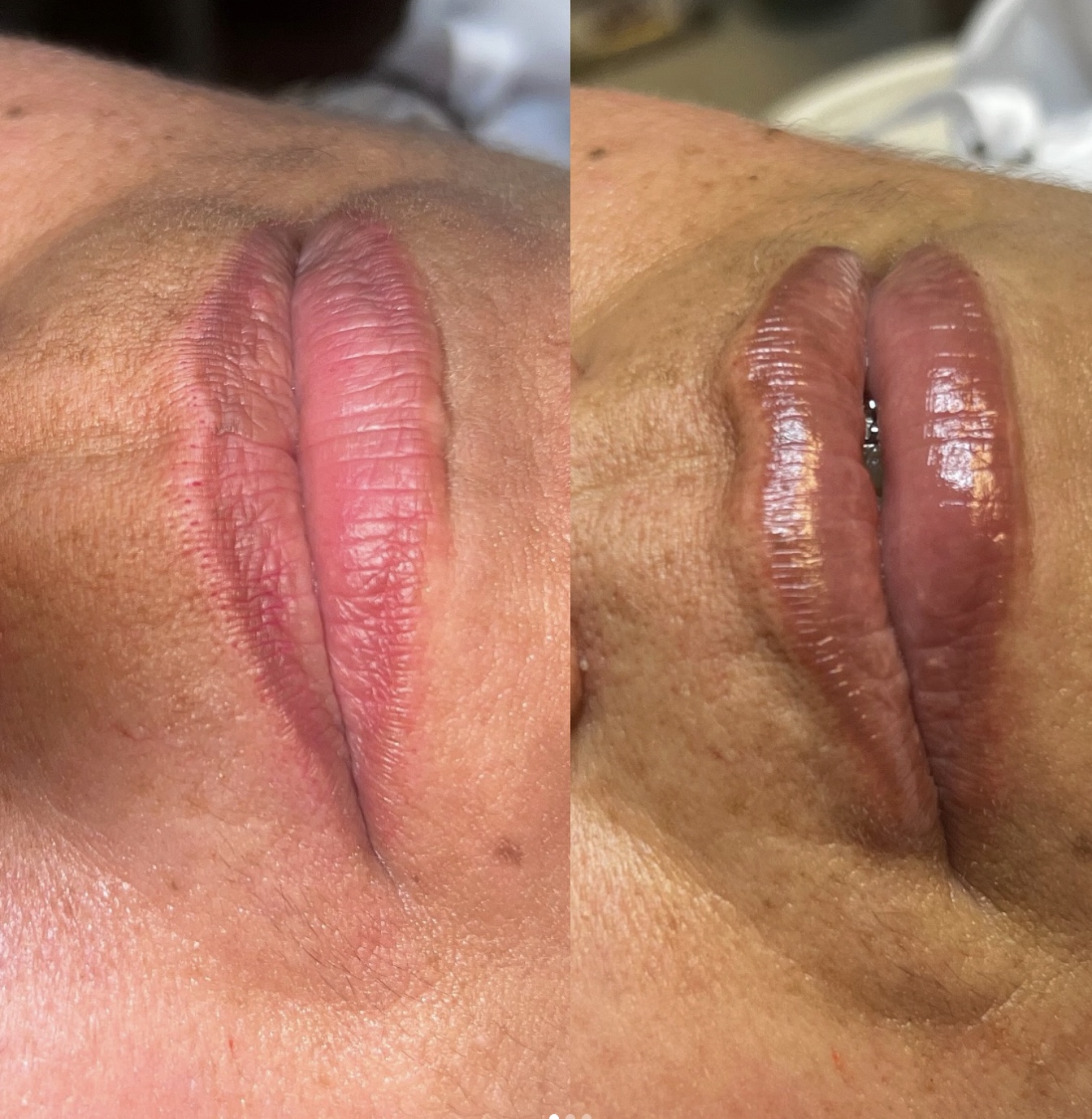 Lip Neutralization before and after by Jamiseth Gallego