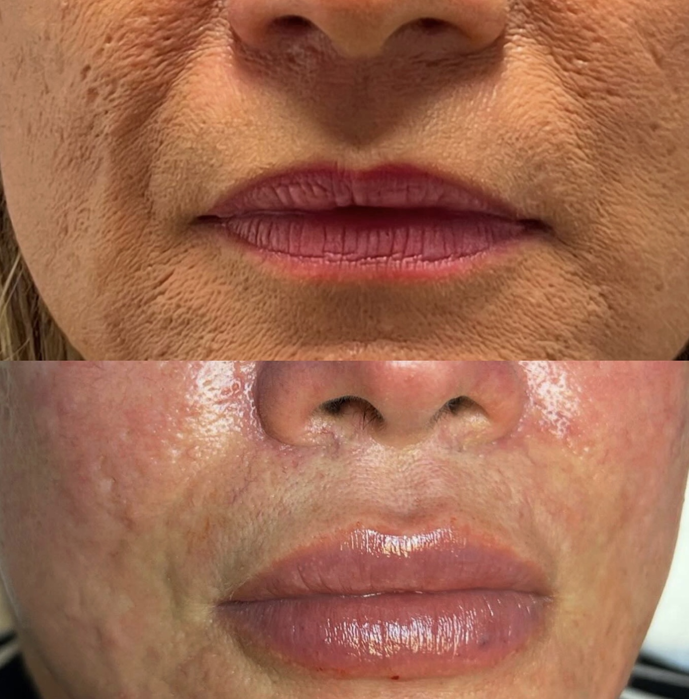 Lip Enhancement before and after by Jamiseth Gallego