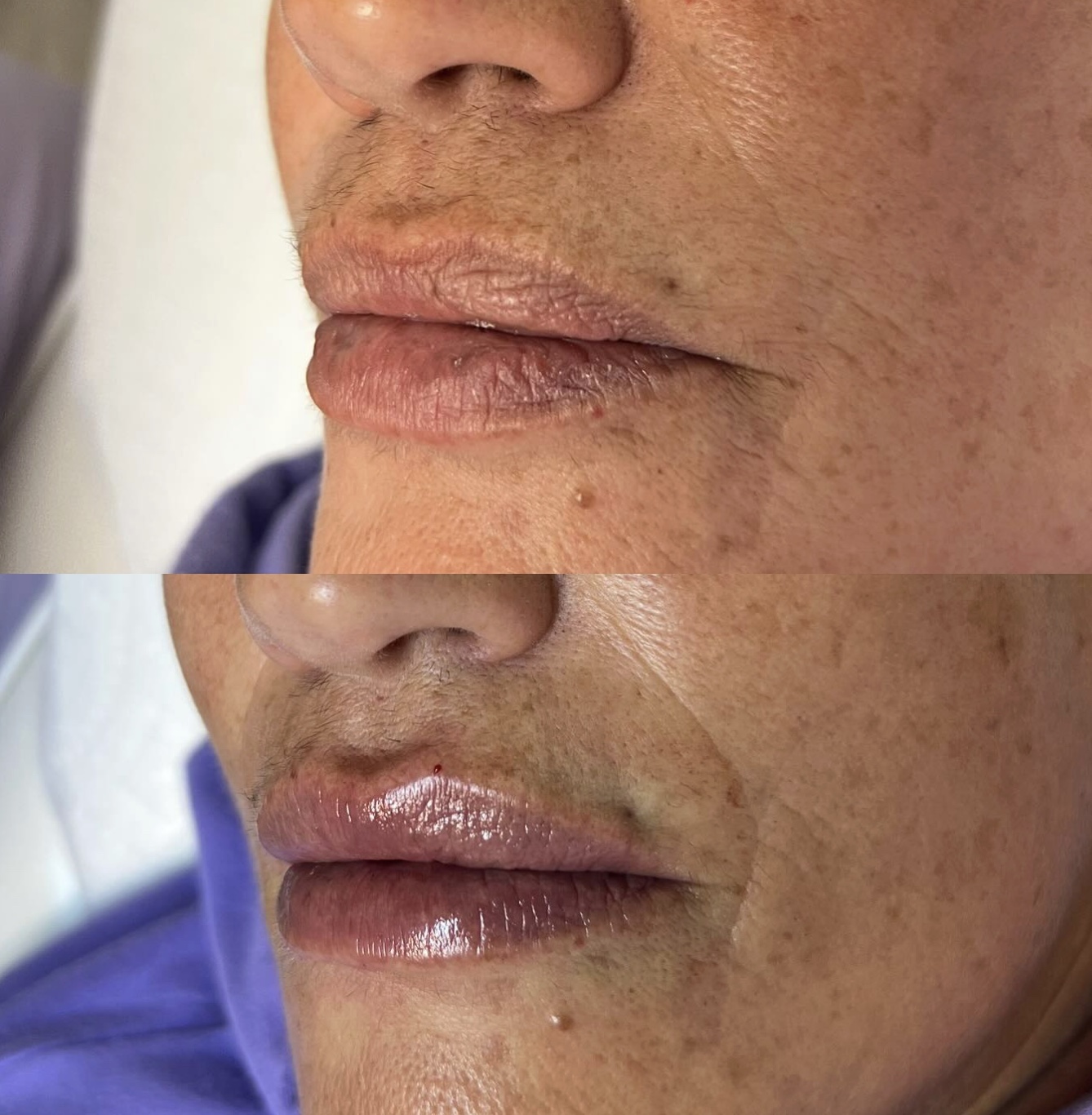Lip Blush before and after by Jamiseth Gallego